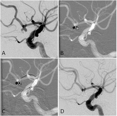 Safety and effectiveness of double microcatheter technique in the treatment of ruptured aneurysms of anterior cerebral circulation